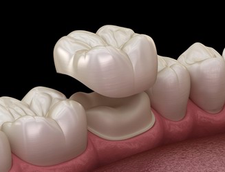 Dental Crown